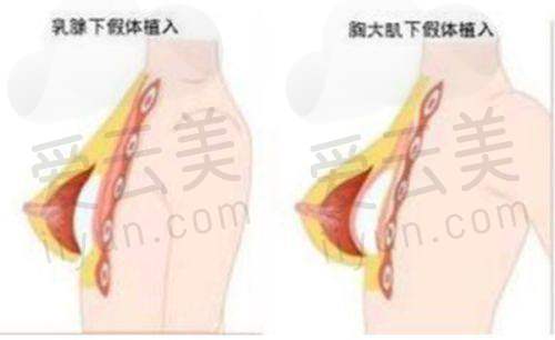 去眼袋项目优势