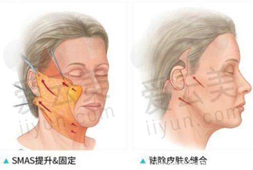 台州维多利亚医疗美容门诊部靠谱吗？黄金微针、双眼皮、吸脂等项目体验和服务究竟咋样